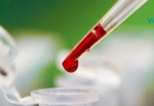 გაწუხებთ ჯანმრთელობის პრობლემები? შესქელებული სისხლი: რა უნდა იცოდეთ ამ დროს..