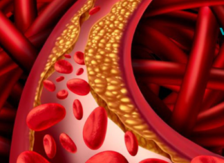 10 საკვები, რომელიც დაგეხმარებათ არტერიების გაწმენდაში..