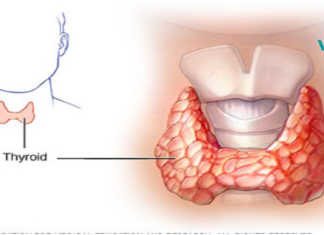 თქვენი ექიმისგან ამას ვერასდროს გაიგებთ: როგორ განკურნოთ ფარისებრი ჯირკვალი მხოლოდ ორი ინგრედიენტით