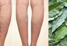 დაფნის ფოთლებით ვენების ვარიკოზისა და სახსრების ტკივილისგან განიკურნებით