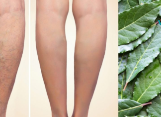 დაფნის ფოთლებით ვენების ვარიკოზისა და სახსრების ტკივილისგან განიკურნებით