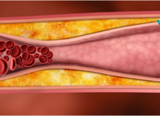 ჩაკეტილი სისხლძარღვების ეფექტური გაწმენდა!