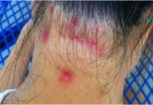 ფიბრომიალგიის სიმპტომები: ნებისმიერს, ვისაც აქვს კუნთების ტკივილი, უნდა წაიკითხოს ეს