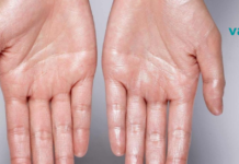 ეს უნდა წაიკითხოთ: როგორ ხდება ბუნებრივი გზით ოფლიანობის თავიდან აცილება!