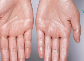 ეს უნდა წაიკითხოთ: როგორ ხდება ბუნებრივი გზით ოფლიანობის თავიდან აცილება!