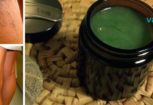 დედამ განკურნა ვარიკოზული ვენები ბებიისგან დარჩენილი ამ მარტივი რეცეპტით