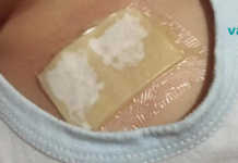 ჯანჯაფილის-თაფლის კომპრესი – მკურნალობს ძლიერ ხველას და აშორებს ლორწოს ფილტვებიდან მხოლოდ ერთ ღამეში!