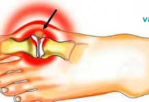 პოდაგრის მკურნალობა იოდითა და ასპირინით: 2 გასაოცარი რეცეპტი!