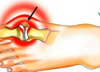 პოდაგრის მკურნალობა იოდითა და ასპირინით: 2 გასაოცარი რეცეპტი!