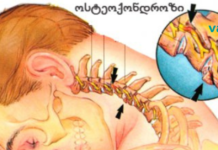 სასწრაფოდ! იცოდით ამის შესახებ? ჰიპერტენზია და ინსულტი – ხერხემლის ოსტეოქონდროზის შედეგებია! ახლავე გაიგეთ, როგორ აიცილოთ თავიდან შესაძლო საფრთხე. .