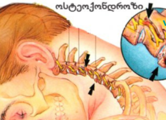 სასწრაფოდ! იცოდით ამის შესახებ? ჰიპერტენზია და ინსულტი – ხერხემლის ოსტეოქონდროზის შედეგებია! ახლავე გაიგეთ, როგორ აიცილოთ თავიდან შესაძლო საფრთხე. .