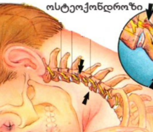 სასწრაფოდ! იცოდით ამის შესახებ? ჰიპერტენზია და ინსულტი – ხერხემლის ოსტეოქონდროზის შედეგებია! ახლავე გაიგეთ, როგორ აიცილოთ თავიდან შესაძლო საფრთხე. .