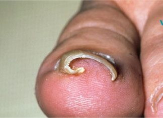 ბებიამ მასწავლა, როგორ ვუმკურნალოთ ჩაბრუნებულ ფრჩხილს. თქვენც მოიშორეთ ეს პრობლემა ერთხელ და სამუდამოდ