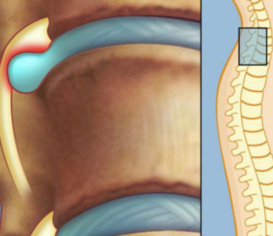 სასწრაფოდ! „მალთაშუა დისკოს თიაქარს ოპერაცია და წამლები არ სჭირდება! უბრალოდ აიღეთ. .“
