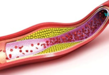 ბუნებრივი სისხლის გამათხელებელი თრომბის თავიდან ასაცილებლად