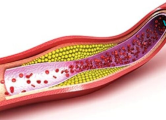 ბუნებრივი სისხლის გამათხელებელი თრომბის თავიდან ასაცილებლად