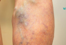 8 წესი, რომელიც უნდა დაიცვათ, თუ ვარიკოზული ვენების განკურნება გსურთ