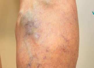 8 წესი, რომელიც უნდა დაიცვათ, თუ ვარიკოზული ვენების განკურნება გსურთ