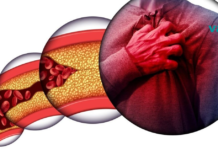 ათეროსკლეროზი – იმკურნალეთ სანამ გვიან არაა. რეცეპტი, რომელიც იდეალურ შედეგს მოგცემთ