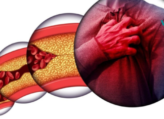 ათეროსკლეროზი – იმკურნალეთ სანამ გვიან არაა. რეცეპტი, რომელიც იდეალურ შედეგს მოგცემთ