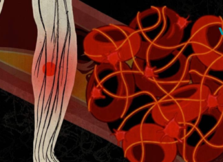 მეგობრებო თრომბოზის მკურნალობა ხალხური საშუალებებითაც შესაძლებელია!!