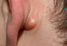 მოიშორეთ ცხიმოვანი კისტა სწრაფად, მარტივად და ეფექტურად ! ეს ყოველივე საოცარია. .