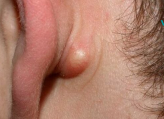 მოიშორეთ ცხიმოვანი კისტა სწრაფად, მარტივად და ეფექტურად ! ეს ყოველივე საოცარია. .