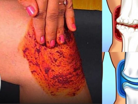 ხალხი გიჟდება ამ რეცეპტზე! რადგან ის სრულფასოვნად კურნავს მუხლის, ძვლებისა და სახსრების ტკივილს!