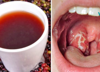 შეგაწუხათ ანგინამ? გამოიყენეთ ეს ნატურალური საშუალება და უკვალოდ გაქრება რამოდენიმე საათში ყველა სიმპტომი. .