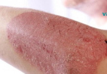 უებარი საშუალება ფსორიაზისთვის! მისი წყალობით კანი მალევე უბრუნდება პირვანდელ სახეს.