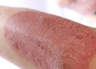 უებარი საშუალება ფსორიაზისთვის! მისი წყალობით კანი მალევე უბრუნდება პირვანდელ სახეს.