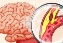 დაკეტილი არტერიების გაწმენდა კვებით: 8 ყველაზე სასარგებლო საკვები