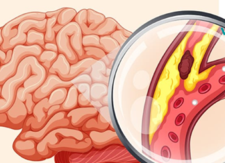 დაკეტილი არტერიების გაწმენდა კვებით: 8 ყველაზე სასარგებლო საკვები