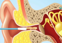 ექიმები ხალხს ევედრებიან, რომ ბამბის ჩხირები არ გამოიყენონ! მიზეზი შეიძლება გაგიკვირდეთ…