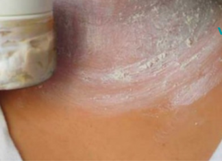 მოიშორეთ მუქი ლაქები კისერზე, მკლავებსა და ბარძაყის შიდა ზედაპირზე!