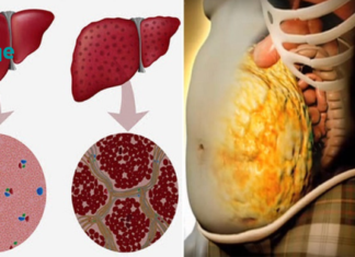 როგორ გავასუფთავოთ ღვიძლი მხოლოდ 72 საათში!?!