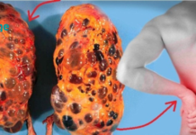 8 ცუდი ჩვევა, რამაც შეიძლება გამოიწვიოს თირკმელების დაზიანება. დაუყოვნებლივ უნდა დაივიწყოთ ესენი. .!