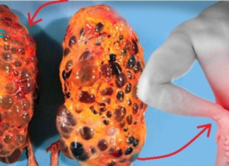 8 ცუდი ჩვევა, რამაც შეიძლება გამოიწვიოს თირკმელების დაზიანება. დაუყოვნებლივ უნდა დაივიწყოთ ესენი. .!