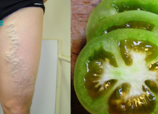 იცოდით, რომ მწვანე პომიდორს შეუძლია დაგეხმაროთ ვარიკოზული ვენების მკურნალობაში?