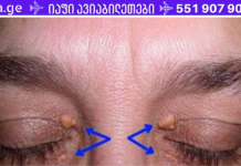 უნდა წაიკითხოთ: გულის შეტევის გამაფრთხილებელი ნიშნები შეიძლება აღმოჩნდეს ქუთუთოებზე!