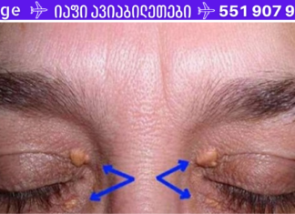 უნდა წაიკითხოთ: გულის შეტევის გამაფრთხილებელი ნიშნები შეიძლება აღმოჩნდეს ქუთუთოებზე!