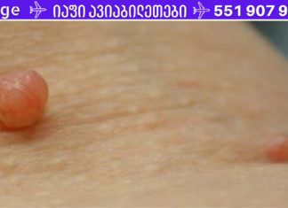 ყველაზე მარტივი და ეფექტური გზა ანოქსიური პაპილომას ბუნებრივად მოსაშორებლად!