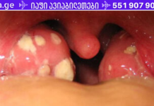 როგორ მოვიშოროთ ტონზილიტი და ანგინა? საუკეთესო გზა! ეს აუცილებლად უნდა იცოდეთ!