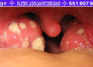 როგორ მოვიშოროთ ტონზილიტი და ანგინა? საუკეთესო გზა! ეს აუცილებლად უნდა იცოდეთ!