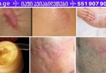 მოიშორეთ ნაწიბურები თქვენი სხეულის ნებისმიერი ნაწილიდან ერთ თვეზე ნაკლებ დროში!