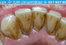 მარტივი გზა სტომატოლოგთან ვიზიტის გარეშე კბილის ქვის მოსაშორებლად. .!