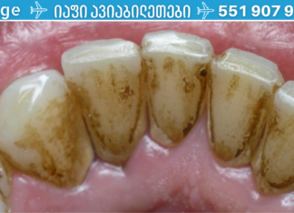 მარტივი გზა სტომატოლოგთან ვიზიტის გარეშე კბილის ქვის მოსაშორებლად. .!