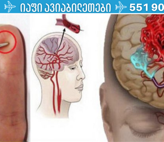 ინსულტის შემთხვევაში, შენს სიცოცხლეს ნემსი გადაარჩენს! ნახეთ, როგორ გაუწიოთ პირველადი დახმარება ინსულტის დროს!