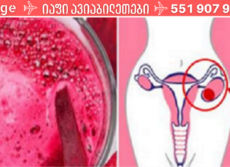 როგორ ვებრძოლოთ საკვერცხის ცისტებსა და მიომას ბუნებრივად! ეს ᲣᲜᲓᲐ ᲬᲐᲘᲙᲘᲗᲮᲝ!