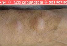 როგორ მოვიშოროთ ცხიმოვანი ქსოვილი (ლიპომები) ხალხური საშუალების დახმარებით!?